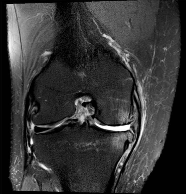 IRM du genou en coupe coronale, pondération T2 : rupture chronique du ligament croisé antérieur avec ménisque interne déficient et arthrose du compartiment fémoro-tibial médial.