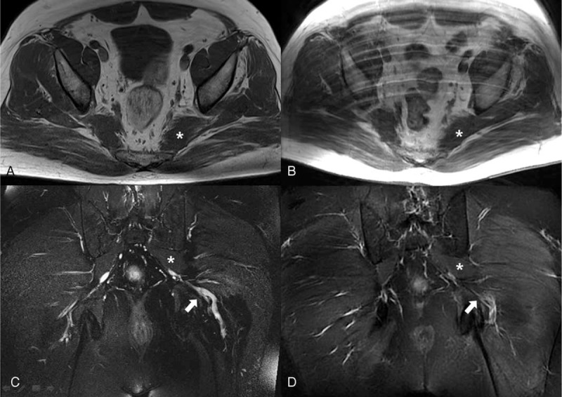 Pelvic MR neurography, axial (A, B) and coronal (C, D) views, before treatment (A, C) and one month after (B, D): hypertrophied left piriformis muscle (asterisk) and sciatic nerve in contact with it (arrow).