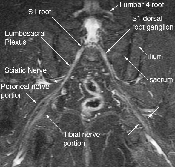 Pelvic MR neurography, coronal view: S1 nerve roots, lumbosacral plexus and proximal sciatic nerve dividing into peroneal and tibial portions at the level of the piriformis muscle.