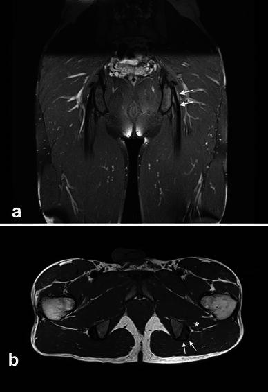 Pelvic MRI, coronal and axial views: tendinopathy of the proximal semimembranosus tendon, arrows on the thickened tendon near the ischium.