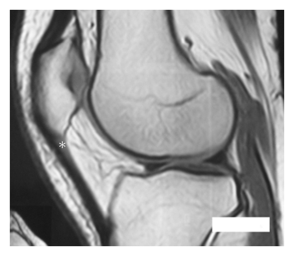IRM de genou en coupe sagittale, préopératoire : zone en hyposignal dans la portion proximale du tendon rotulien, astérisque, tendinopathie rotulienne chronique.