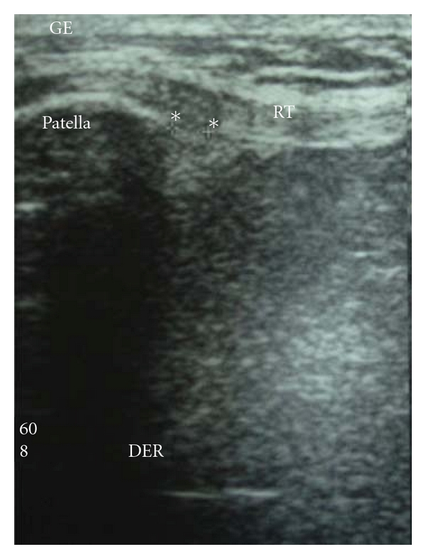 Échographie du tendon rotulien, préopératoire : zones hypoéchogènes correspondant à un œdème tendineux, astérisques, sous la rotule.