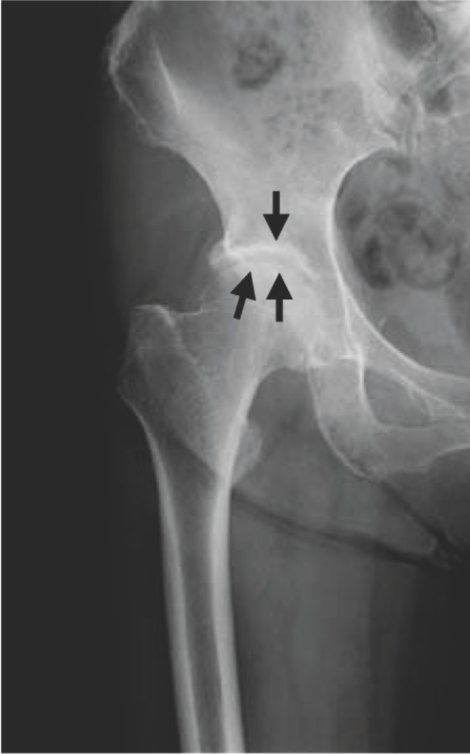 Radiographie du bassin de face : coxarthrose débutante avec pincement de l'interligne articulaire de la hanche droite (flèches), sans déformation majeure de la tête fémorale.
