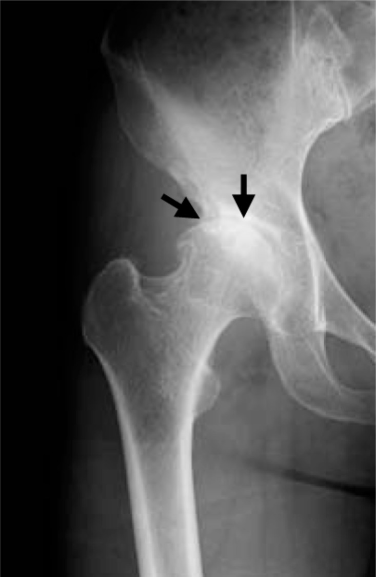 Radiographie du bassin de face : coxarthrose sévère avec disparition quasi complète de l'interligne, ostéophytes, ostéosclérose sous-chondrale et déformation de la tête fémorale (flèches).